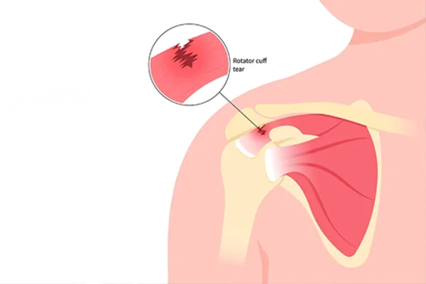 Shoulder Surgery and Rotator Cuff Tear Management